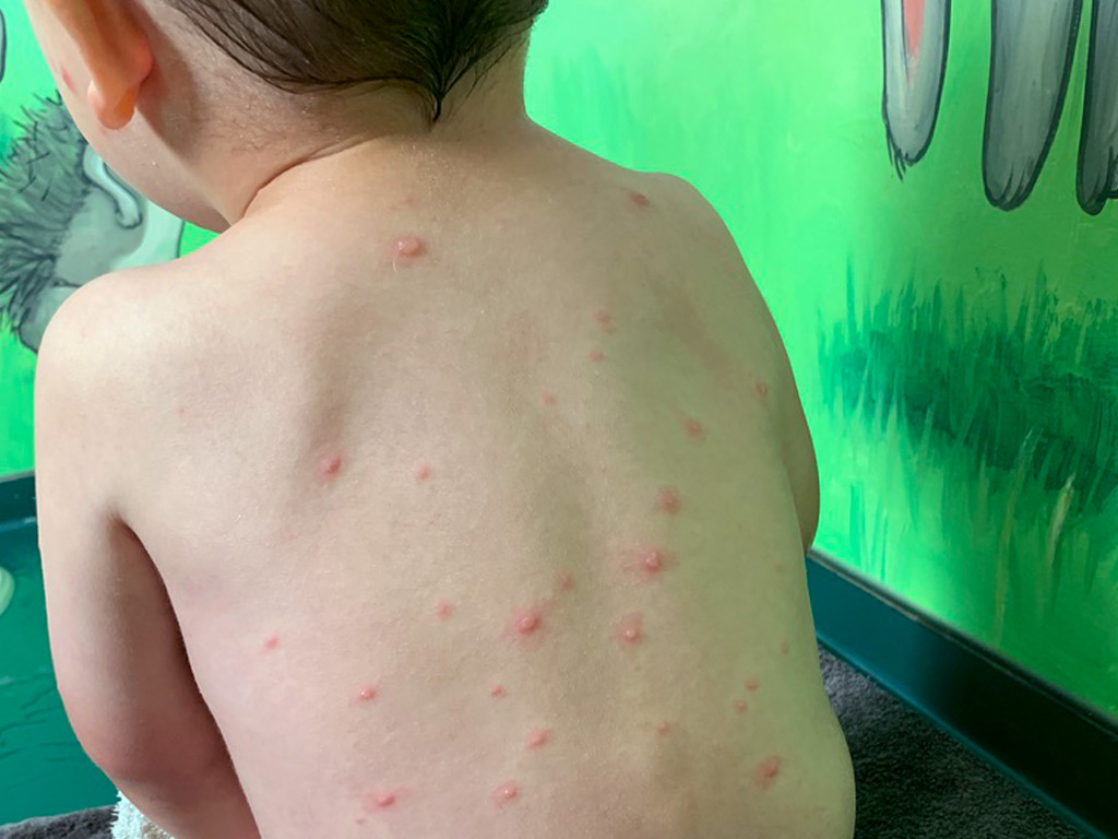 Windpocken im Urlaub