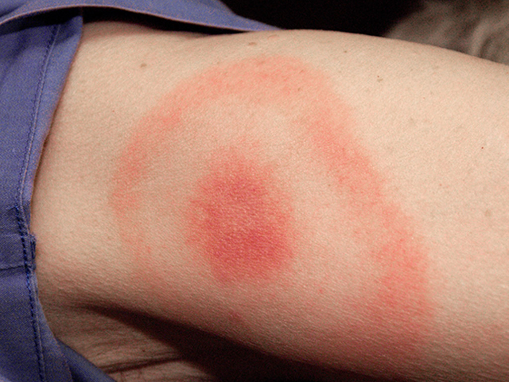 Behalten Sie den Zeckenbiss im Auge