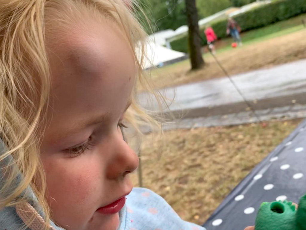 Sturz- und Beulensalbe gegen Schwellungen